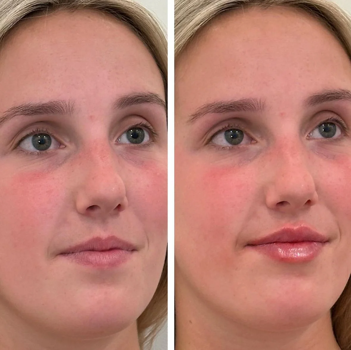 Signature Lips before and after 1