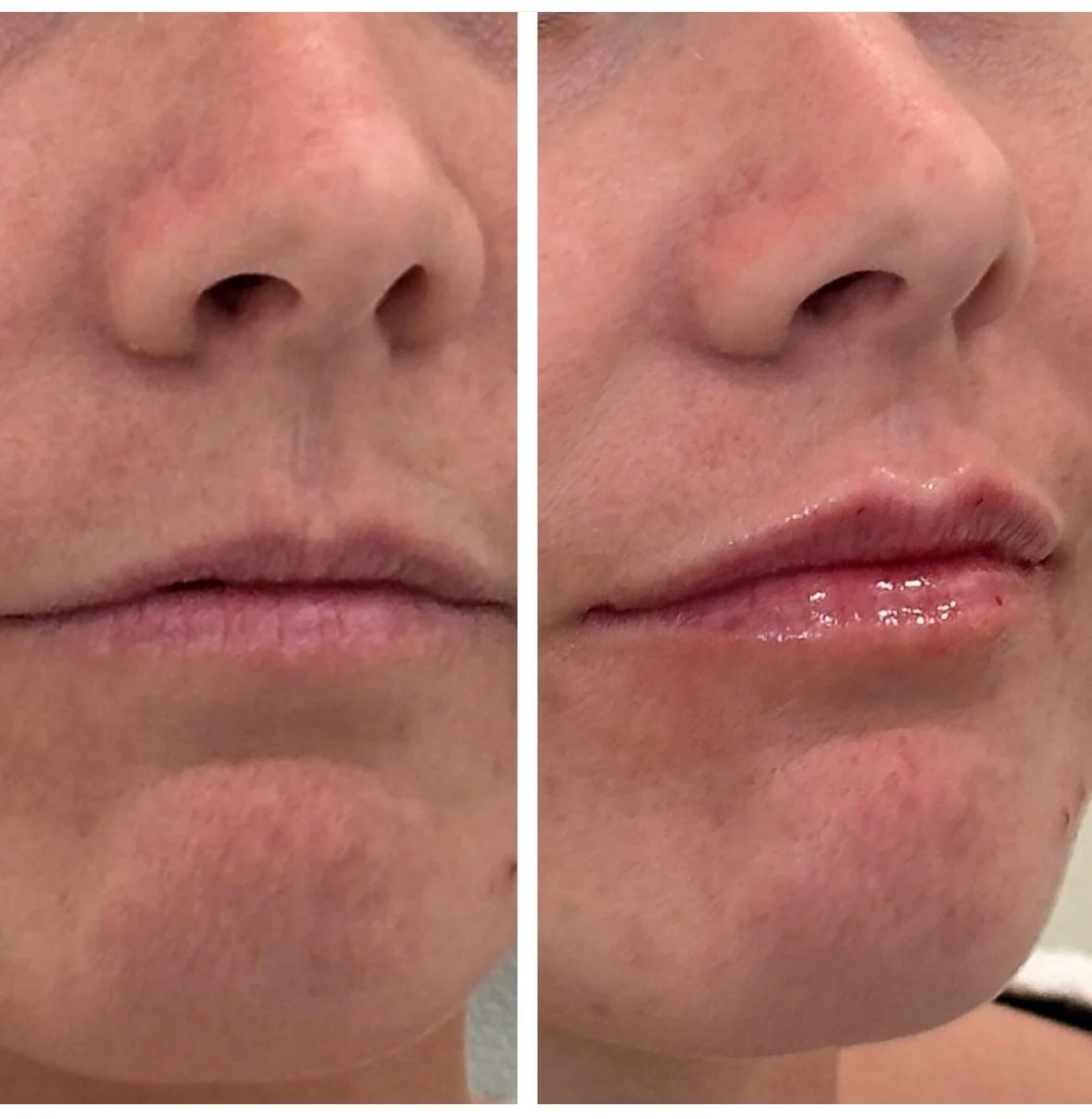 Signature Lips before and after 2