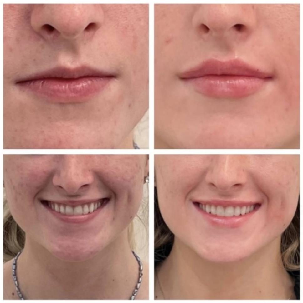 Signature Lips before and after 3