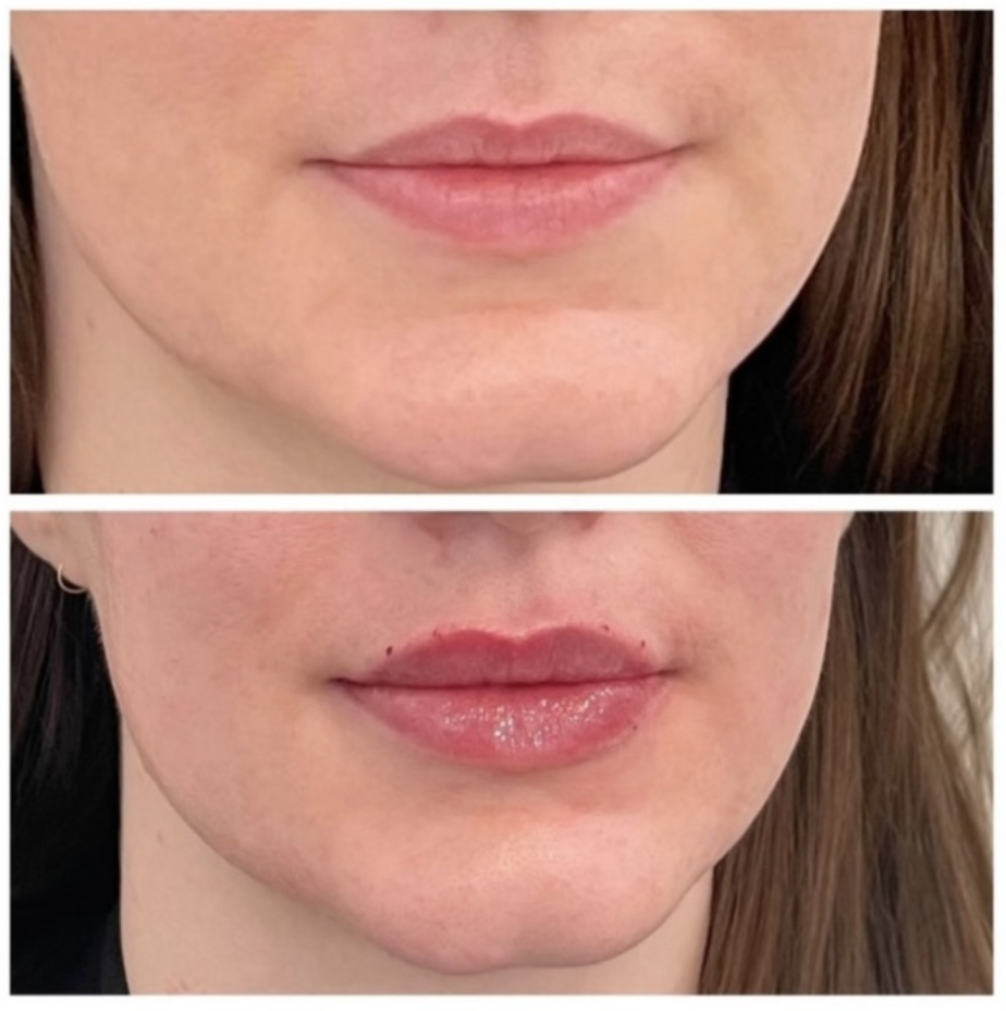 Signature Lips before and after 4