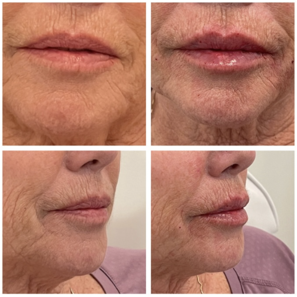 Signature Lips before and after 7