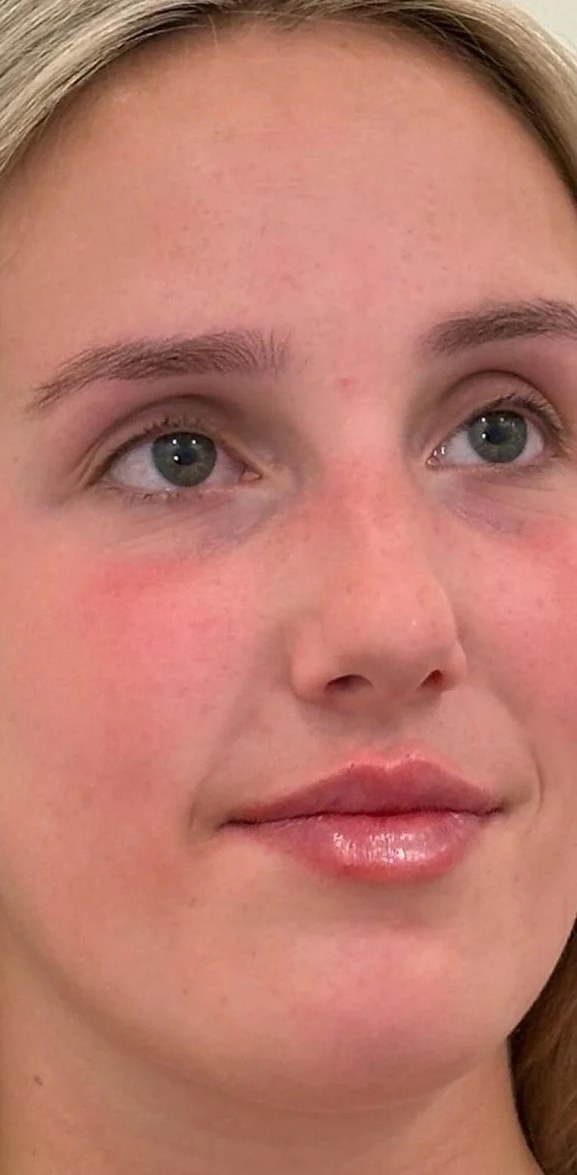Lip Filler after